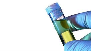 Καρκίνος προστάτη: Αναπτύσσεται τεστ ούρων που θα γίνεται στο σπίτι